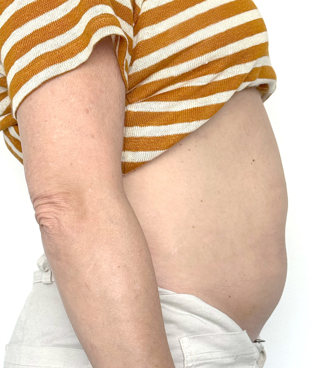 Antes Fisioestetica Gines Sevilla