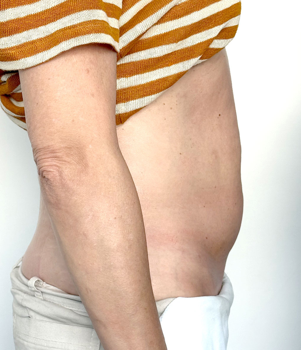 Despues Fisioestetica Gines Sevilla